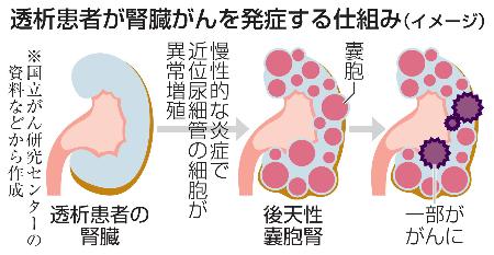 　透析患者が腎臓がんを発症する仕組み（イメージ）